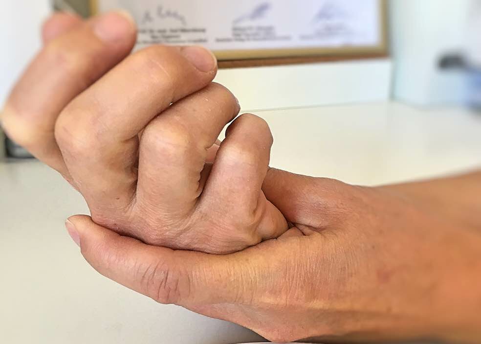 Effektive Therapie bei Sehnenscheidenentzündung: Sofortige Maßnahmen und langfristige Strategien